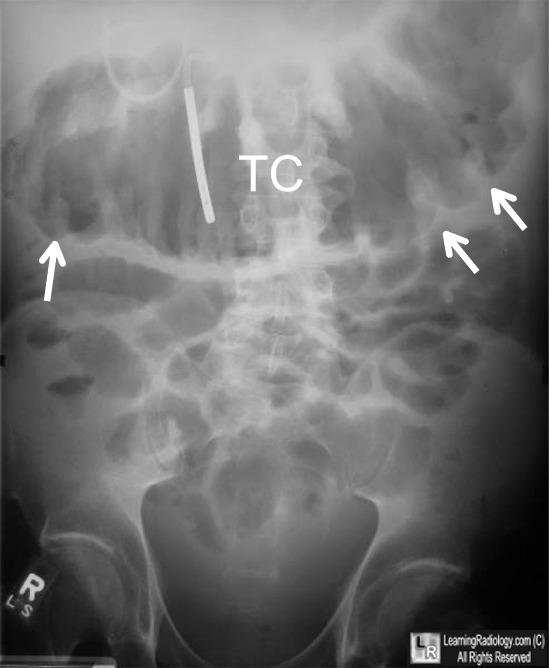 Ischemic Thumbprinting Ischemic Colitis